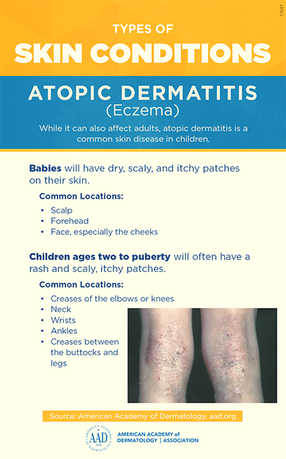 American academy of dermatology guideline atopic dermatitis